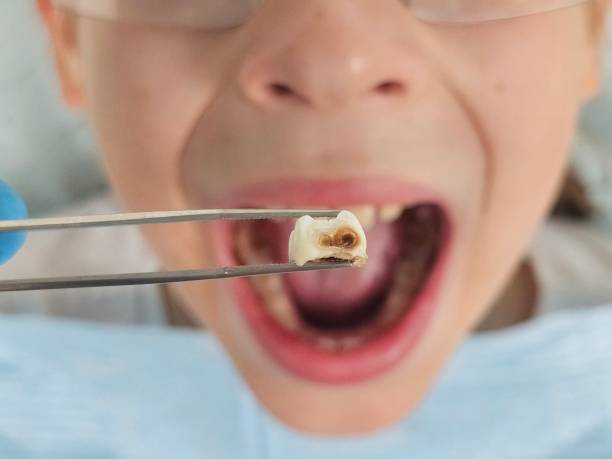 Best Emergency Wisdom Teeth Removal in West Milton, OH